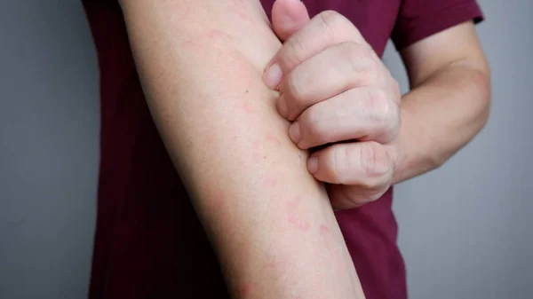 Close Image Man Arm Suffering Severe Urticaria Hives Allergy Symptoms — Stockfoto
