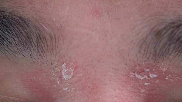close-up view of man with psoriasis near the eyebrows