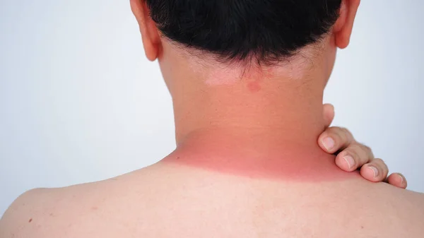 redness on the man neck of sunburn, close-up view