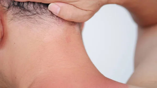 close-up view of redness on the man neck of sunburn