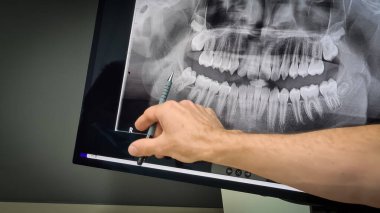 Orthodontist showing V-ray of teeth for patient. Sydney, 17 january 2023.