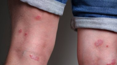 Cropped shot of psoriasis patches on a man legs. 