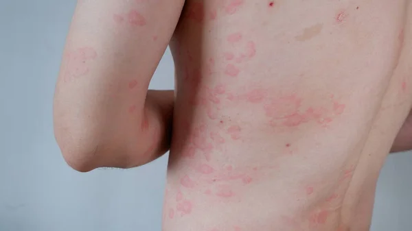 Close Image Skin Texture Suffering Severe Urticaria Hives Allergy Symptoms — 图库照片