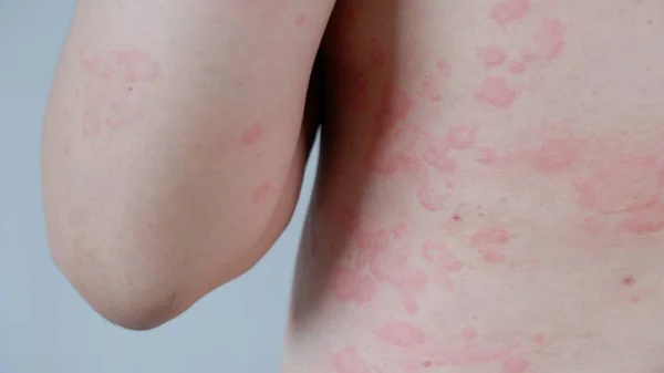 Close up image of skin texture suffering severe urticaria or hives. Allergy symptoms.