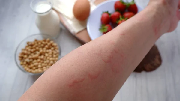 Close up image of arm suffering severe urticaria or hives or kaligata with ilustration of allergy trigger foods.  Eggs, milk, beans, strawberry, and chesse.