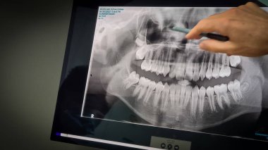 An orthodontist showing V-ray of teeth for patient. Sydney, 17 january 2023.