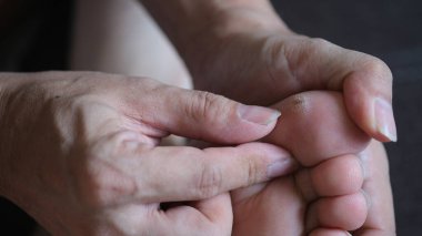 Balık gözü ya da ayak parmağı üzerinde Clavus..