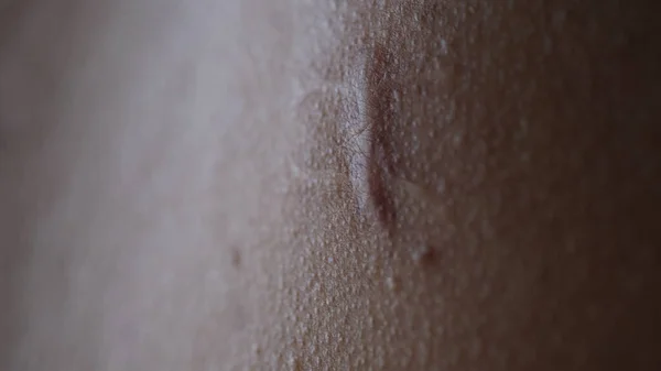 Keloid También Conocido Como Trastorno Queloide Cicatriz Queloidal Resultado Crecimiento — Foto de Stock