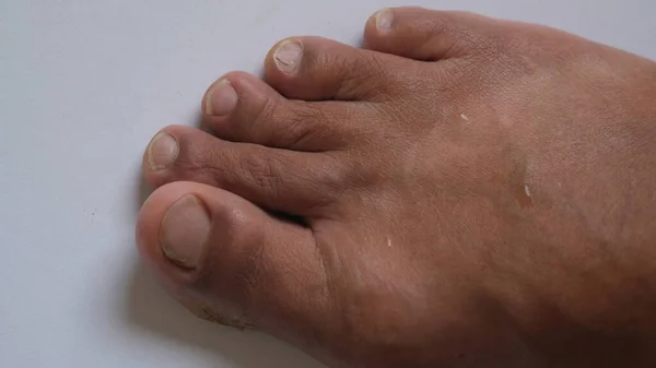 Initial Signs Tailor Bunion Foot Deformity — Stock Photo, Image