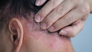 psoriasis on the nape of a man. skin with psoriasis. clipart