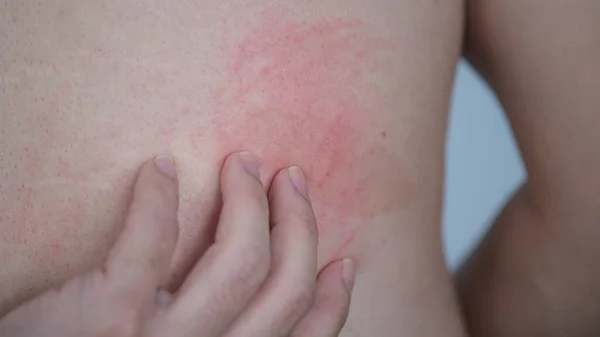 Close Image Skin Texture Suffering Severe Urticaria Hives Kaligata Back — Stock Photo, Image