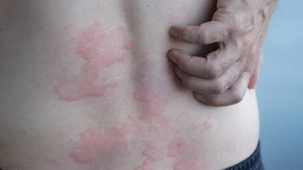 Sırtında şiddetli ürtiker, kurdeşen ya da kaligata olan deri dokusunu kapat.