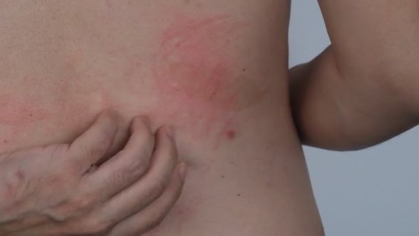 Man Scratching His Allergic Skin — Stock Video