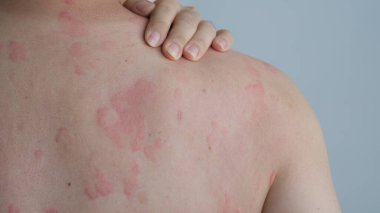 Close up image of skin texture suffering severe urticaria or hives or kaligata on back. Allergy symptoms.