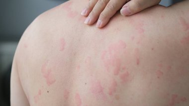 Close up image of skin texture suffering severe urticaria or hives or kaligata on back. Allergy symptoms.