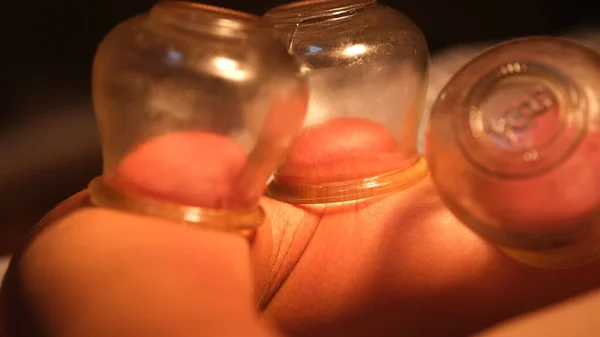 Traditional Chinese Cupping on a hand.