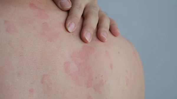 stock image Close up image of skin texture suffering severe urticaria or hives or kaligata on back. Allergy symptoms.
