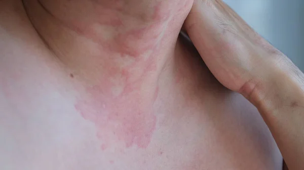 Close Image Skin Texture Suffering Severe Urticaria Hives Kaligata Neck — Stock Photo, Image