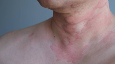 Close up image of skin texture suffering severe urticaria or hives or kaligata on neck. Allergy symptoms. clipart