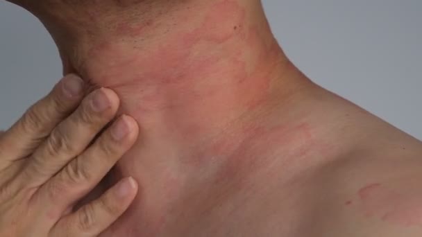 Itchy Allergic Reaction Rash Blisters On Stock Footage Video (100
