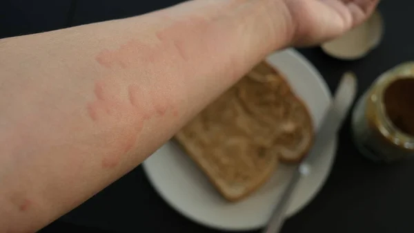 重度の白癬やじんましんやアレルギー誘発性食品のイラストとKaligataに苦しむ腕のイメージを閉じます ピーナッツバター — ストック写真