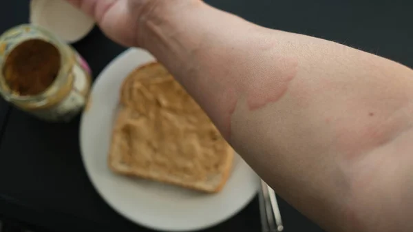 用过敏触发食物的例子 近距离观察手臂严重荨麻疹或荨麻疹或鹰嘴豆的图像 花生酱 — 图库照片