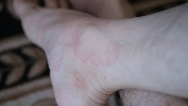 Allergie Auf Den Fußsohlen Vor Dem Hintergrund Staubiger Teppiche — Stockfoto