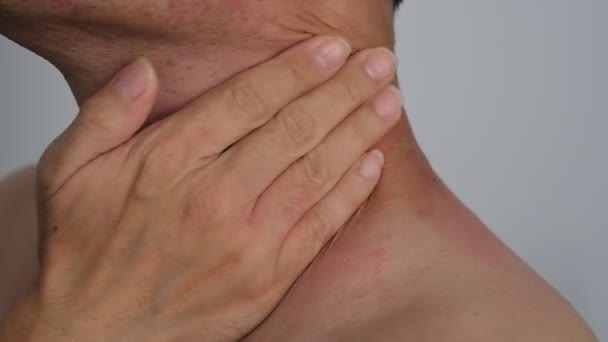 Close Image Skin Texture Suffering Severe Urticaria Hives Kaligata Neck — Stock Video