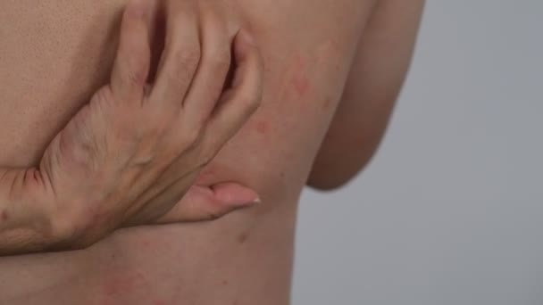 一个男人在挠他的过敏性荨麻疹皮肤 — 图库视频影像