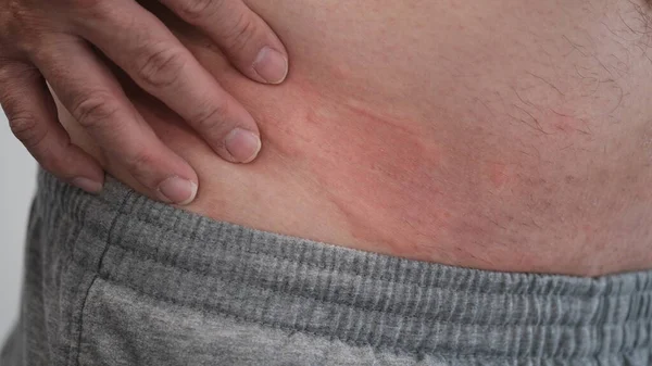 Chiudi Pelle Orticaria Orticaria Allergia Intorno Alla Vita Uomo — Foto Stock