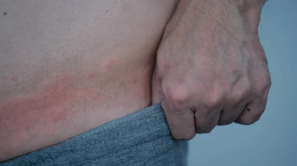 Close Urticária Urticária Alergia Torno Cintura Homem — Fotografia de Stock