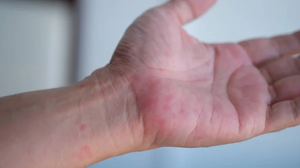 Κυψέλες Του Δέρματος Αλλεργίες Στις Παλάμες Κνίδωση Biduran — Φωτογραφία Αρχείου