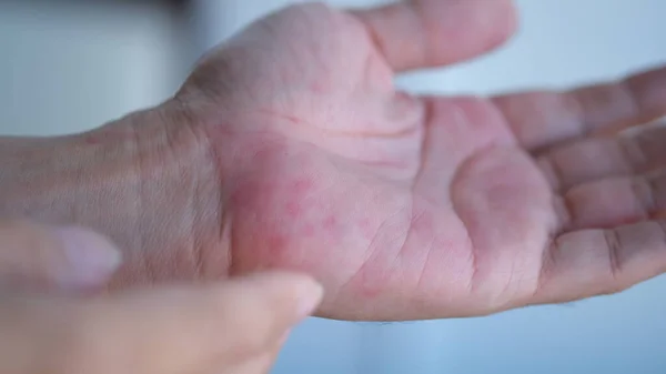 Pele Urticária Alergias Nas Palmas Das Mãos Urticária Biduran — Fotografia de Stock