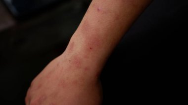 Şiddetli ürtiker, kovan ya da kaligata geçiren kolun görüntüsünü kapat. Alerji hazır..