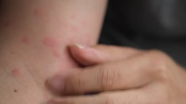 심각한 비뇨기과 하이브 칼리가타로 고통받는 이미지 — 비디오