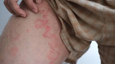 Şiddetli ürtiker, kurdeşen ya da kaligata çeken deri dokusunu yakından çek. Alerji belirtileri..