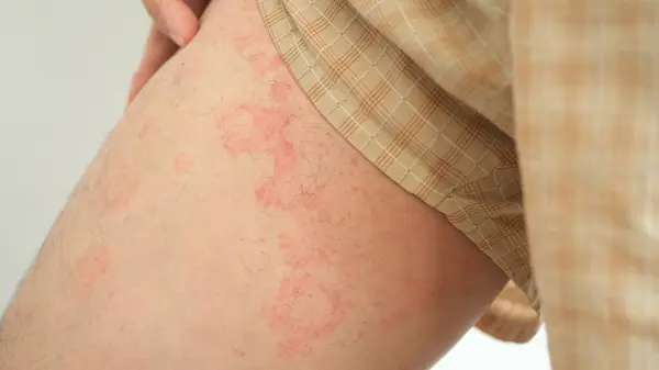stock image Close up image of skin texture suffering severe urticaria or hives or kaligata on a man's thighs. Allergy symptoms.