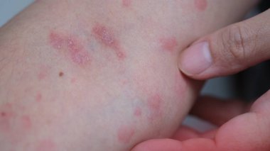 İnsan eli Prosiasis ve şiddetli ürtiker ya da kovanlardan acı çekmeye başlar..