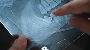 Panoramic Xray of Impacted wisdom teeth. clipart