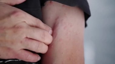 Eller alerjik bir kolu kaşındırıyor şiddetli ürtiker, kovan ya da kaligata yüzünden acı çekiyor..