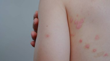 Bir adamın sırtında küçük sedef hastalığı paketleri. Sedef hastalıklı deri..