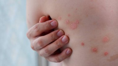 Bir adamın sırtında küçük sedef hastalığı paketleri. Sedef hastalıklı deri..