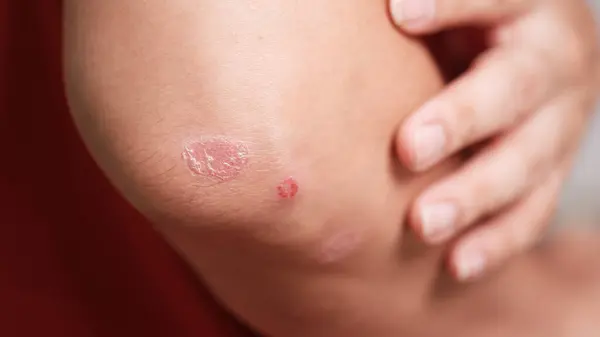 Bir adamın dirseğinde küçük bir sedef hastalığı var. Bazıları kanayacak kadar çizilmiş..