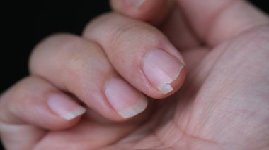 Beslenme yetersizliğinden dolayı tırnakları kırılmış..