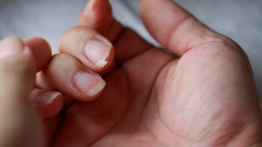 Beslenme yetersizliğinden dolayı tırnakları kırılmış..