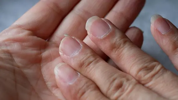 Beslenme yetersizliğinden dolayı tırnakları kırılmış..