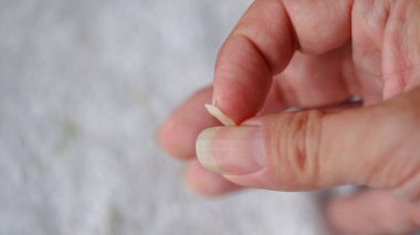Beslenme yetersizliğinden dolayı kırık tırnaklar..