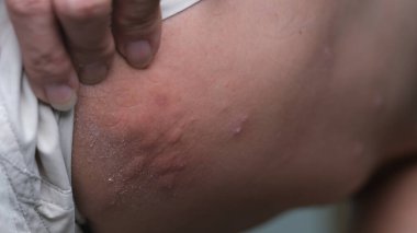 Deri dokusu şiddetli ürtiker, kurdeşen, kaligata ya da bir erkeğin uyluklarında görülen alerjiler. Alerji belirtileri..