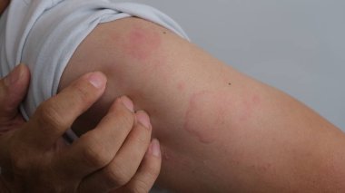 Şiddetli ürtiker, kurdeşen ya da bir adamın kolundaki kaligata gibi deri dokusunu yakından çek. Alerji belirtileri..