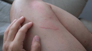 Şiddetli ürtiker, kurdeşen ya da kaligata çeken deri dokusunu yakından çek. Alerji belirtileri..